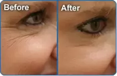 Botox before and after pictures