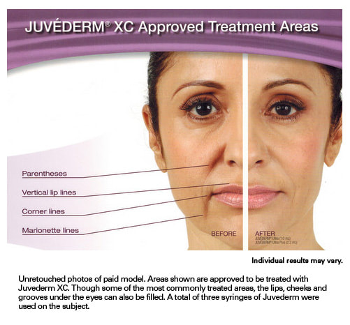 JUVÉDERM® XC Approved Treatment Areas
